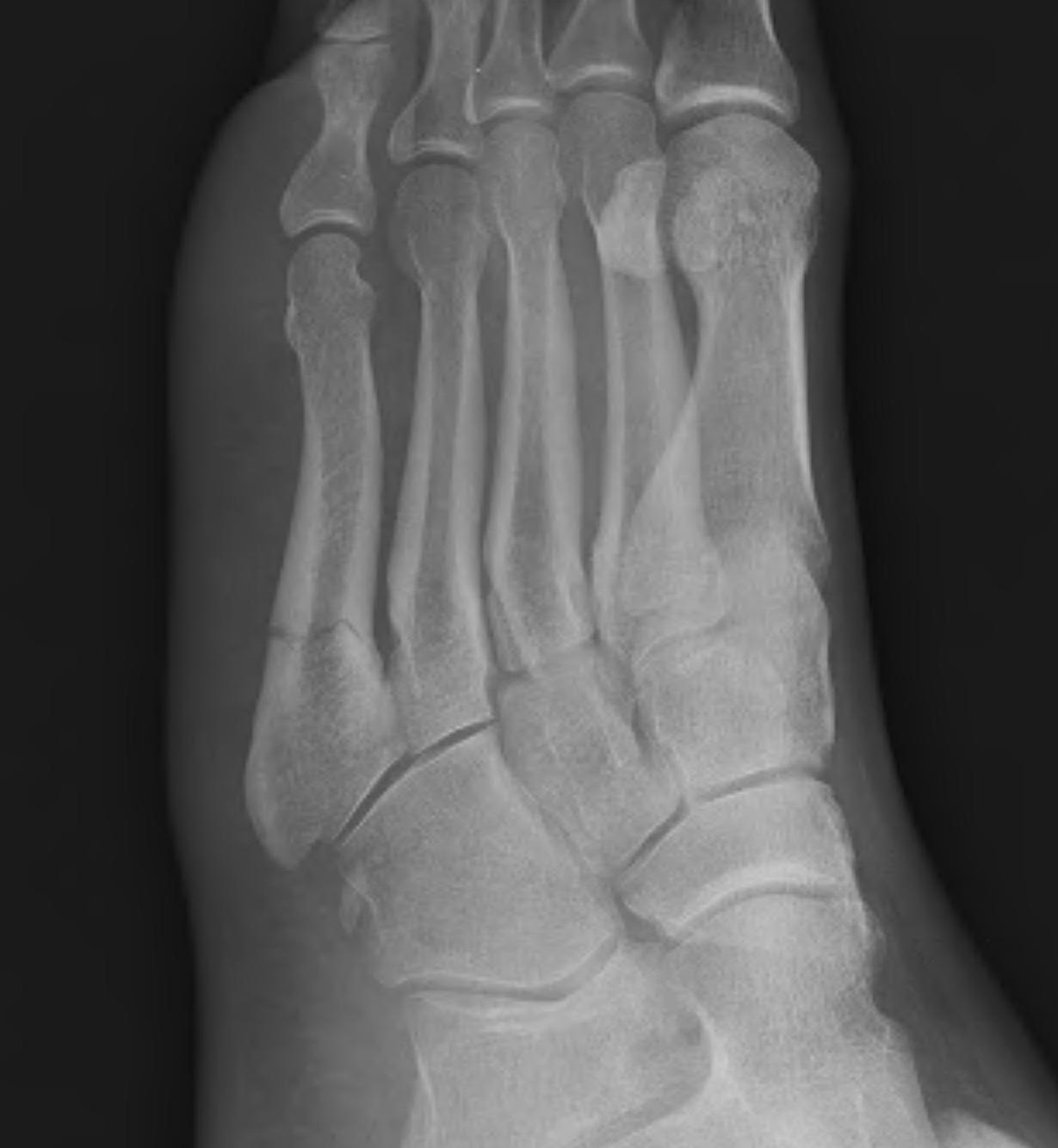 Metatarsal Fractures The Bone School